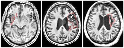 TransRender: a transformer-based boundary rendering segmentation network for stroke lesions